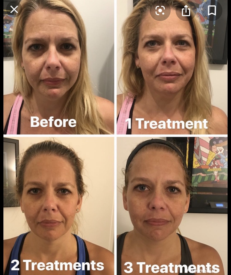 Cryoskin Facial 3 treatments before and after