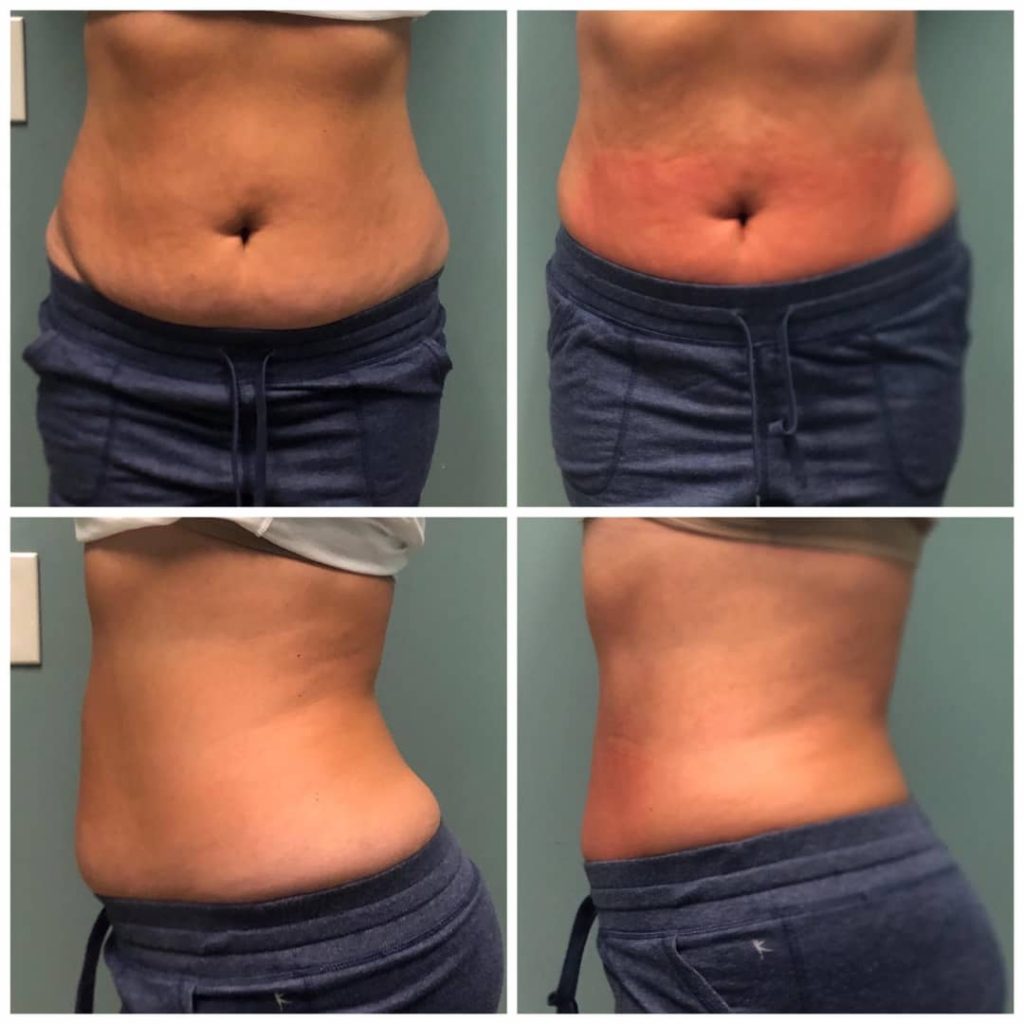 Cryoskin before and after abs and sides
