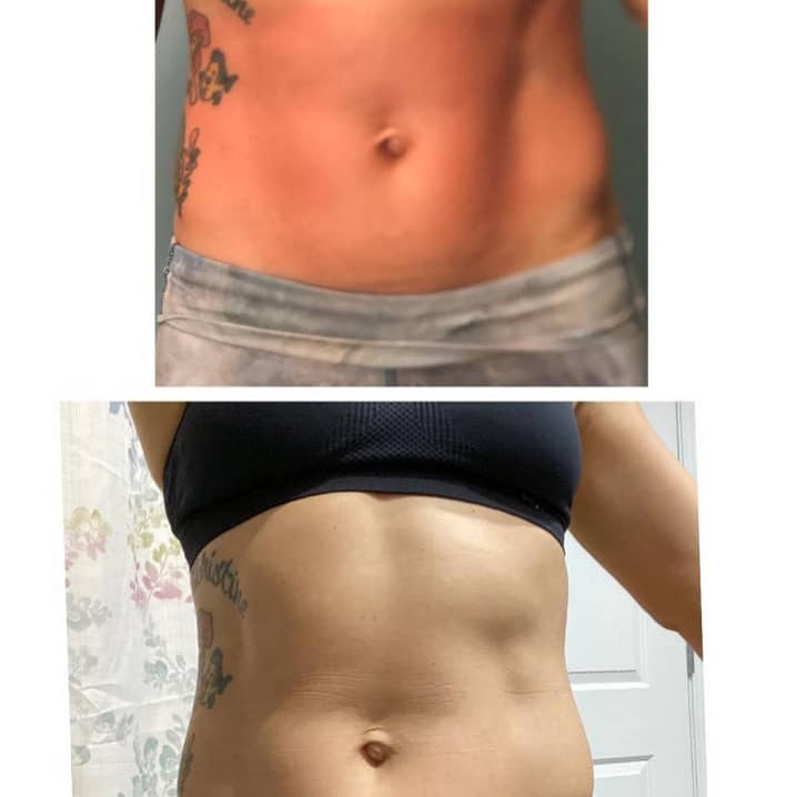 EMSculpting Therapy before and after 4 weeks