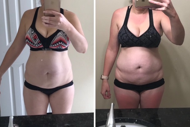 Laser Lipo female before and after 10 treatments