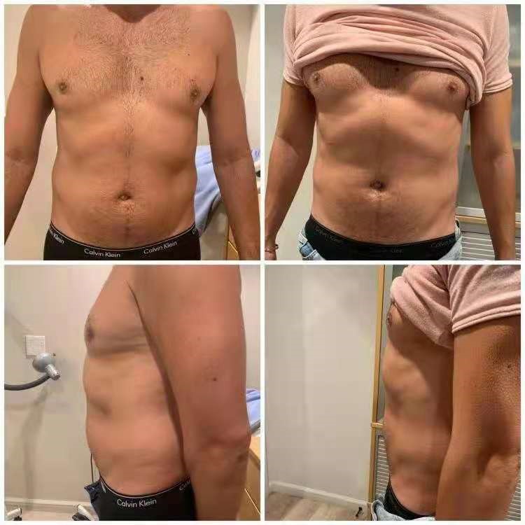 Laser Lipo male before and after 10 treatments