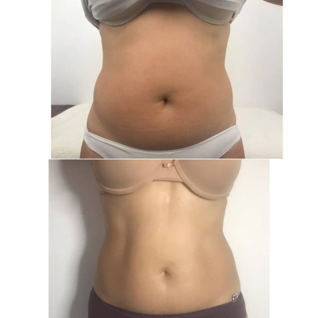 Laser Lipo treatments before and after 10 treatments